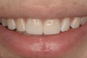 前歯のラミネートベニア・オールセラミッククラウンの症例（口元）